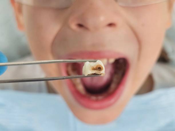 Best Emergency Wisdom Tooth Extraction in Lauderdale, MN