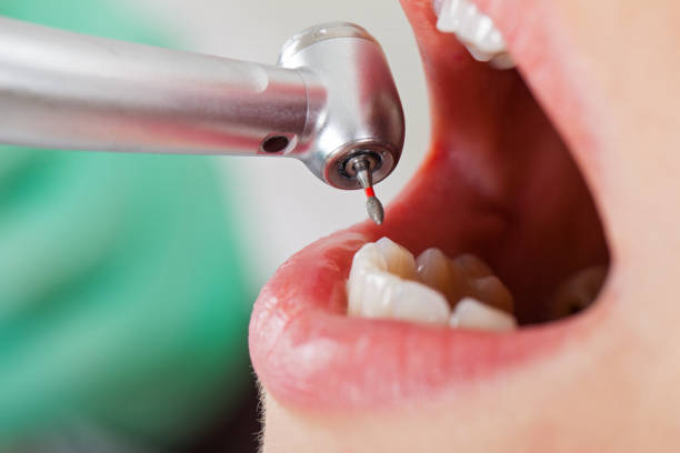 Best Broken or Chipped Tooth Repair in Lauderdale, MN